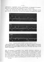 Fig. 23. Dissociation auriculo-ventriculaire et grossesse (Jeannin et A. Clerc) - Titres et travaux  [...]