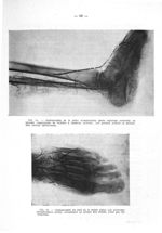 Fig. 54. Radiographie de la pièce d'amputation après injection artérielle au lipiodol (amputation de [...]