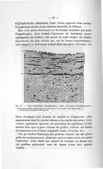 Fig. 13. Veine artérialisée - Titres et travaux scientifiques