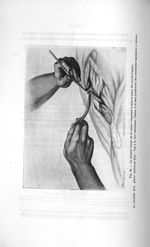 Fig. 30. Le premier temps de la suture comprend la mise en place des points d'appui - Titres et trav [...]