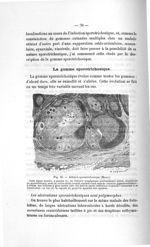 Fig. 35. Adénite sporotrichosique (Moure) - Titres et travaux scientifiques