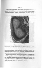 Fig. 36. Adénite sporotrichosique - Titres et travaux scientifiques