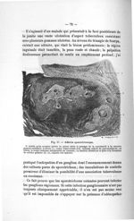 Fig. 37. Adénite sporotrichosique - Titres et travaux scientifiques