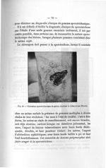 Fig. 38. Ulcération sporotrichosique du genou simulant la tuberculose (Moure) - Titres et travaux sc [...]
