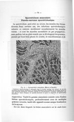 Fig. 41. Sporotrichose musculaire. (Moure et Beaufle) - Titres et travaux scientifiques