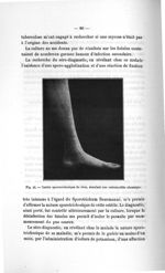 Fig. 42. Ostéite sporotrichosique du tibia, simulant une ostéomyélite chronique - Titres et travaux  [...]