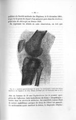 Fig. 43. Arthrite sporotrochosique du genou. La radiographie montre des lésions manifestes de l'épip [...]