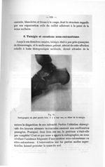 Fig. 51. Radiographie du pied gauche faite, il y a sept ans, au début de la talalgie - Titres et tra [...]