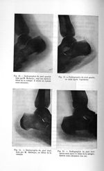 Fig. 52. Radiographie du pied gauche faite par M. Malméjac, sept ans après le début de la talalgie / [...]