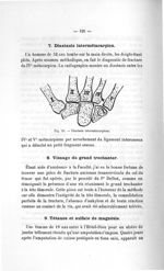 Fig. 58. Diastasis intermétacarpiens - Titres et travaux scientifiques