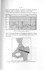 Fig. 60. Vissage du col fémoral pour fracture. Schéma de la radiographie - Titres et travaux scienti [...]