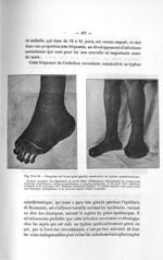 Fig. 79 et 80. Gangrène de l'avant-pied gauche consécutive au typhus exanthématique - Titres et trav [...]