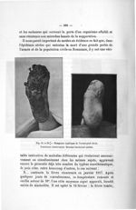 Fig. 81 et 82. Gangrène typhique de l'avant-pied droit - Titres et travaux scientifiques