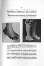 Fig. 83 et 84. Gangrène typhique de l'avant-pied droit - Titres et travaux scientifiques