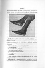 Fig. 86. Gangrène des deux jambes consécutive au typhus exanthématique - Titres et travaux scientifi [...]