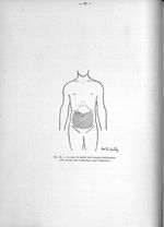Fig. 25. La zone de matité des tumeurs épiploïques ; elle occupe tout l'abdomen, sauf l'épigastre -  [...]