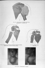 Fig. 45. Ostéosarcome de l'humérus (Prof. Estor). Radiographie le 3 novembre 1908 / Fig. 46. Ostéosa [...]