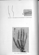 Fig. 62 et 63. Absence apparente de la verge, malformation de la muqueuse préputiale / Fig. 64. Luxa [...]
