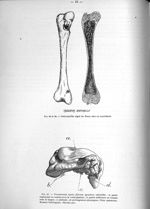 Fig. 65 et 66. Ostéomyélite aiguë du fémur chez un nourrisson / Fig. 67. Volumineuse épulis fibreuse [...]