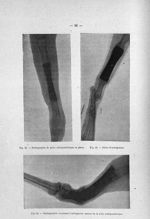 Fig. 20. Radiographie de pièce endoprothétique en place / Fig. 21. Début d'ostéogénèse / Fig. 22. Ra [...]
