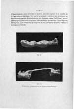 Fig. 23 / Fig. 24. Productions osseuses autour de la pièce endoprothétique - Exposé des titres et tr [...]