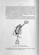 Fig. 29. La pneumectomie partielle. Pose d'un clamp et section du parenchyme déchiqueté - Exposé des [...]