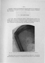 Fig. 52. Greffe d'une extrémité supérieure du fémur et fracture de cal (Küttner) - Exposé des titres [...]