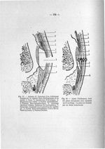 Fig. 57. Schéma (J. Ducuing) d'un évidement complet de la capsule fibro-cartilagineuse de la rotule  [...]