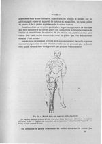 Fig. 61. Malade dans son appareil plâtre-feuillard - Exposé des titres et travaux scientifiques