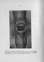 Fig. 63. Le genou, après résection et écartement en extension. Cette figure donne une idée exacte de [...]