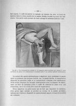 Fig. 68. Vue d'ensemble du malade et de l'appareil plâtre-feuillard qui permet la mise en flexion du [...]