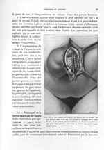 Fig. 16. Le ventre est ouvert en dehors de la hernie, ce qui permet dans les cas où l'épiploon s'eng [...]