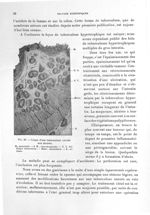 Fig. 29. Coupe d'une tuberculose caecale non ulcérée - Titres et travaux scientifiques