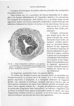 Fig. 32. Coupe d'appendicite consécutive à une annexite - Titres et travaux scientifiques