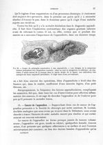 Fig. 33. Coupe de salpingite consécutive à une appendicite - Titres et travaux scientifiques