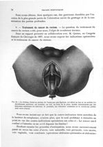 Fig. 44. Le rectum, fermé au niveau de l'anus par une ligature, est attiré en bas et en arrière. Le  [...]