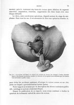 Fig. 45. Le rectum est libéré en avant et en arrière ; le coccyx est réséqué. L'index, introduit dan [...]