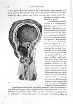Fig. 48. Résultat d'une prostatectomie transvésicale récente - Titres et travaux scientifiques