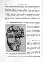 Fig. 55. Coupe de l'utérus avec suppuration et gangrène débutant dans la capsule des fibromes - Titr [...]