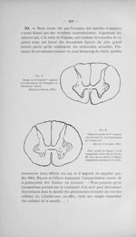 Fig. I. Coupe au niveau du 8me segment cervical dans un cas d'atrophie de l'héminence thénar. (Prévo [...]
