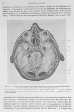 Fig. 1. Coupe de tronçonnage médio-nasale, montrant la portion endo-crânienne de l'artère méningée m [...]