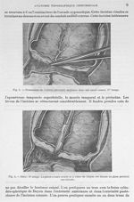 Fig. 5. Ecrasement de l'artère méningée moyenne dans son canal osseux. 1er temps / Fig. 6. Idem. 2èm [...]
