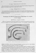 Fig. 21. Séries de tubes pharyngés de grosseur diverses - Archives de Doyen. Revue médico-chirurgica [...]