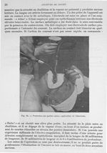 Fig. 24. Protection des parties saines, application de l'électrode - Archives de Doyen. Revue médico [...]
