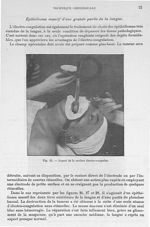 Fig. 25. Aspect de la surface électro-coagulée - Archives de Doyen. Revue médico-chirurgicale illust [...]