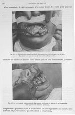 Fig. 26. Epithélioma massif des deux tiers antérieurs de la langue / Fig. 27. Le malade est anesthés [...]