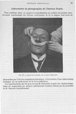 Fig. 28. Aspect de la langue, un an après l'opération - Archives de Doyen. Revue médico-chirurgicale [...]