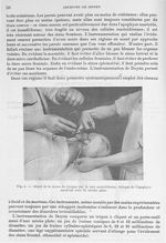 Fig. 4. Abord de la caisse du tympan par la voie mastoïdienne. Attaque de l'apophyse mastoïde avec l [...]