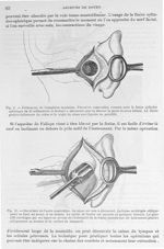 Fig. 9. Evidement de l'apophyse mastoïde / Fig. 10. Ouverture de l'antre mastoïde. Le sinus est mis  [...]