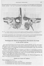Fig. 19. Coupe verticale du rocher gauche - Archives de Doyen. Revue médico-chirurgicale illustrée